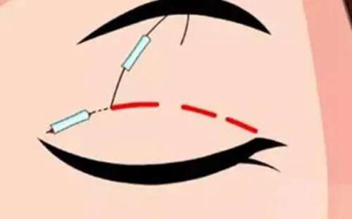 郑庆桂做双眼皮好不好？价格表和医院信息速来了解！